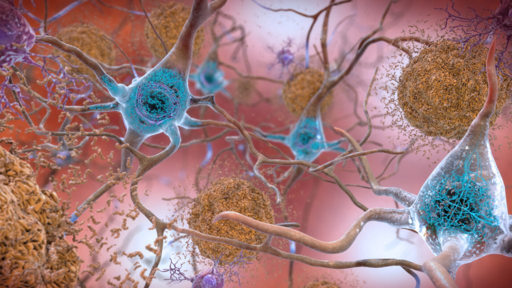 New Alzheimer’s drug, lecanemab, may slow cognitive decline in early alzheimer’s disease