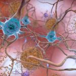 New Alzheimer’s drug, lecanemab, may slow cognitive decline in early alzheimer’s disease